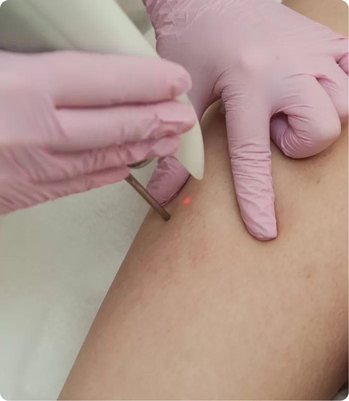 THERMOCOAGULATION img